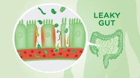 
Holistic Healing for Leaky Gut